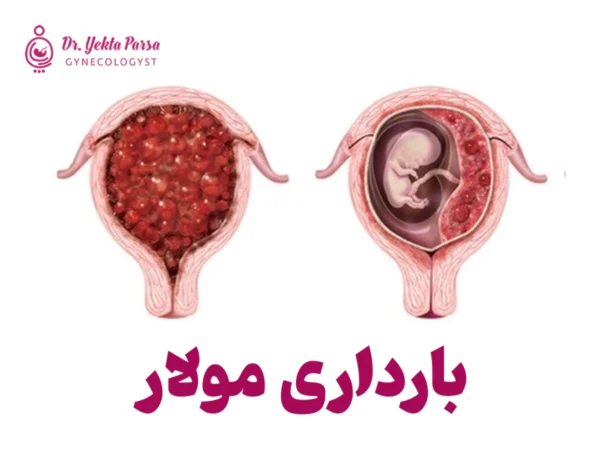 بارداری مولار