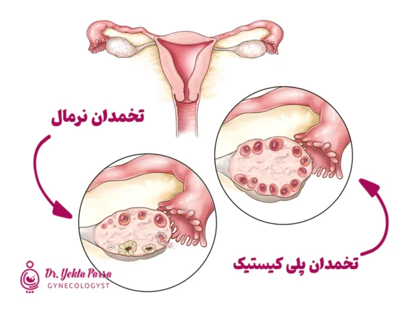 سندم تخمدان پلی کیستیک