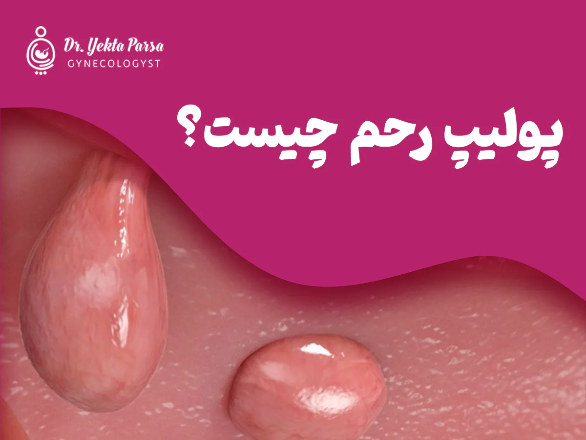 پولیپ رحم - دکتر یکتا پارسا